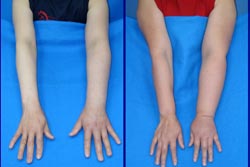 Lymphedema Arms
