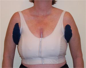 Lymphedema Fullness in the Armpits