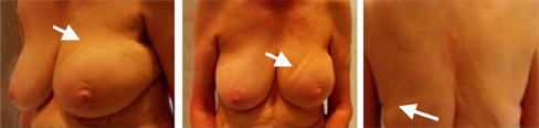 Truncal Lymphedema Following Breast Cancer Surgery