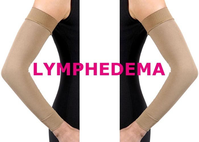 Lymphedema